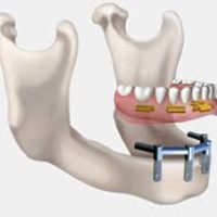 Pose de 4 implants dentaires avec une barre d'attachement