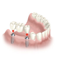 Prothèses sur implant
