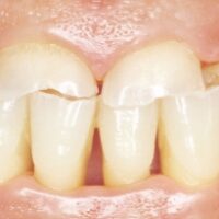 Bruxisme (grincement de dents)