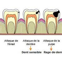Comment se forment les caries ?