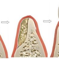 Greffes osseuses avant implant