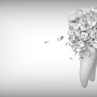gingivite-tartre-dechaussement-dents